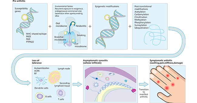 類風濕性關(guān)節(jié)炎的發(fā)病途徑